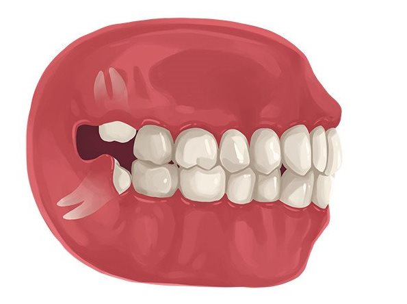 زمان جراحی دندان عقل
