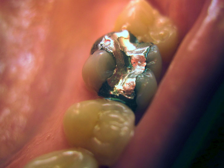 انواع مواد برای پر کردن دندان