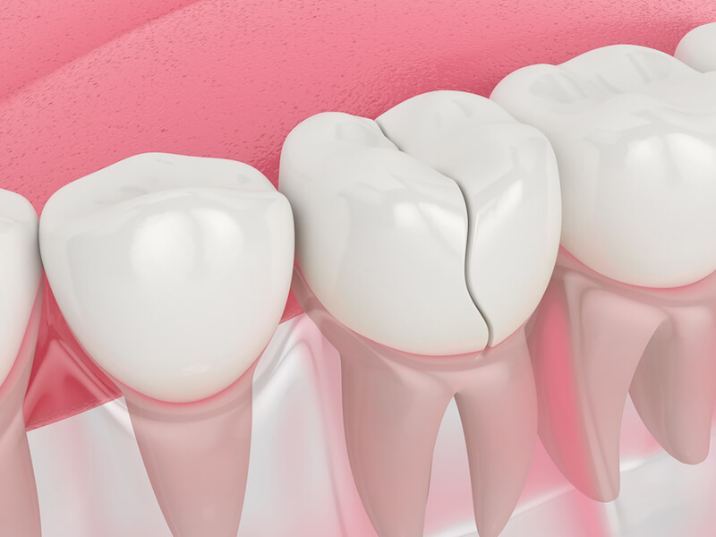 درمان ترک مویی دندان