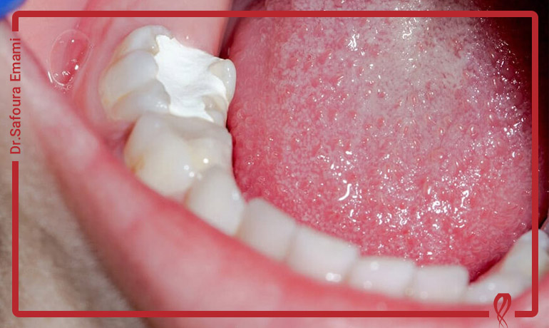 دلیل اصلی پانسمان دندان عصب کشی شده چیست؟