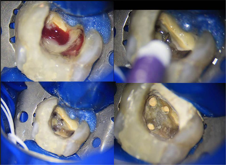 عصب کشی 4 کانال (MB-2) دندان
