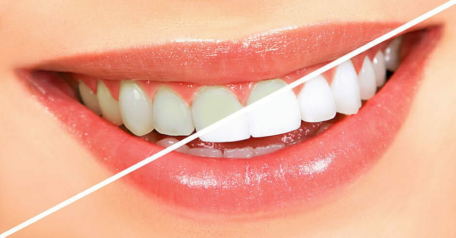 سفید کردن دندان‌ها 