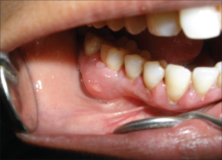 جراحی دندان عفونی