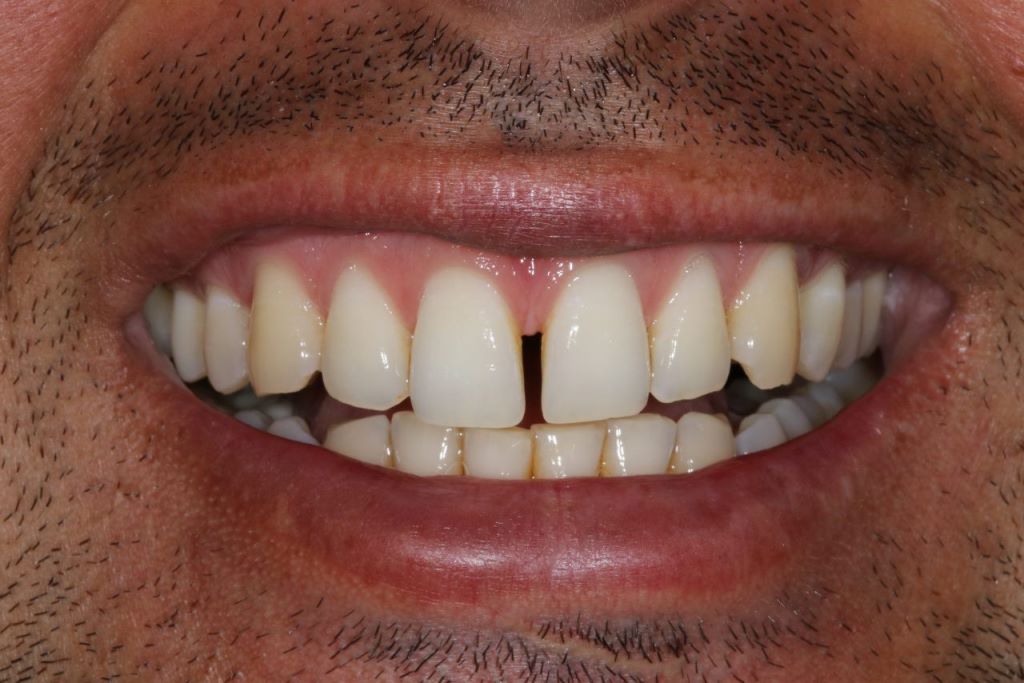 درمان فاصله بین دندان جلو
