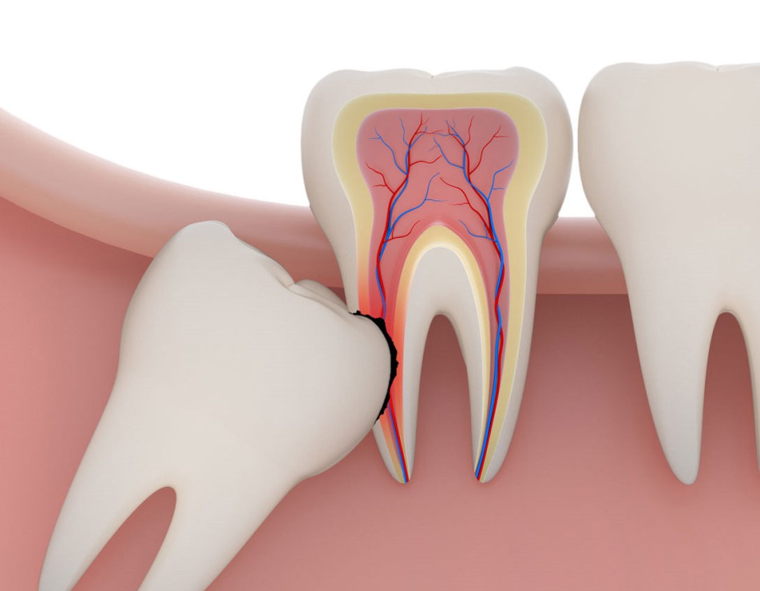 جراحی دندان