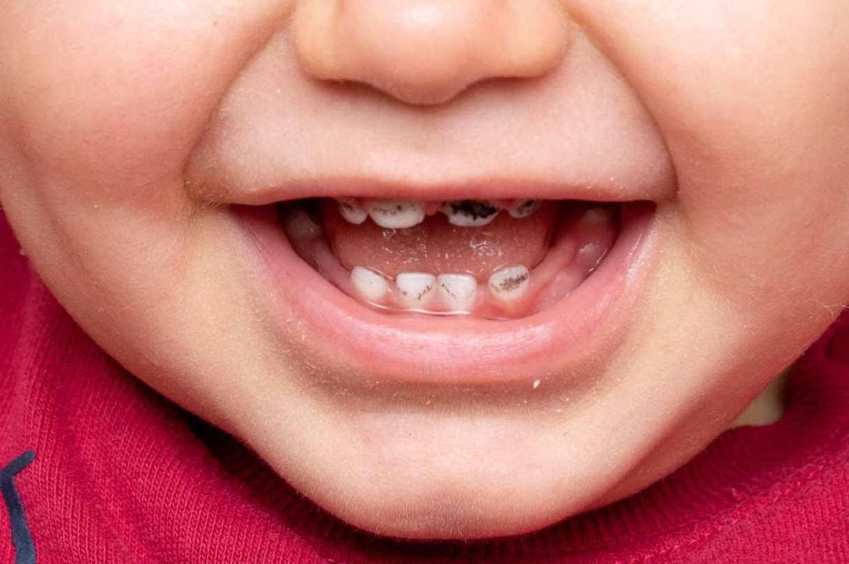 علت پوسیدگی دندان کودک