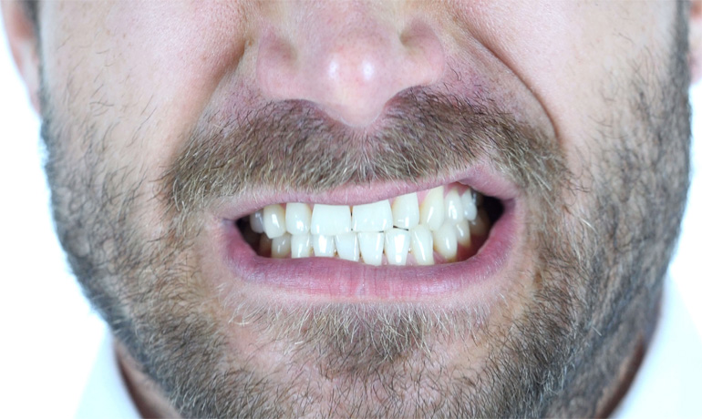 دندان قروچه چیست و علل و نحوه درمان آن