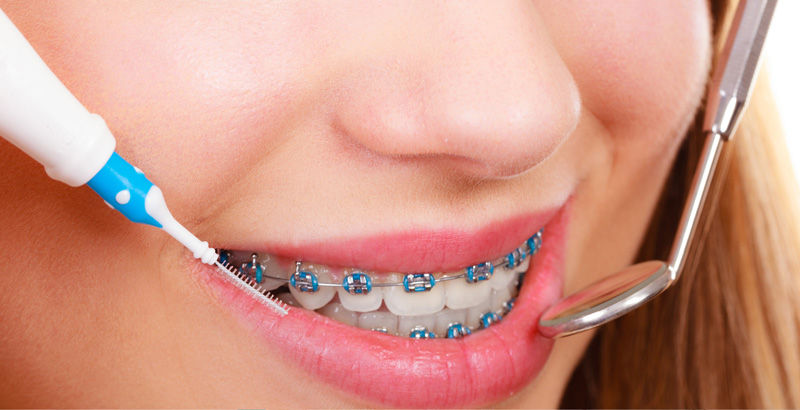 مراحل انجام ارتودنسی دندان