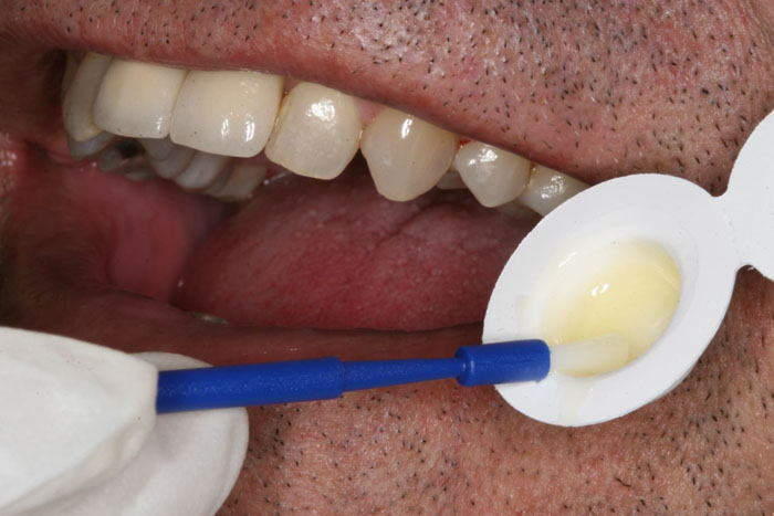 مراحل انجام فلوراید تراپی دندان
