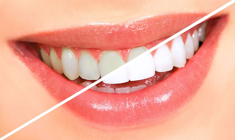 آشنایی با روش‌های سفید کردن دندان‌ها