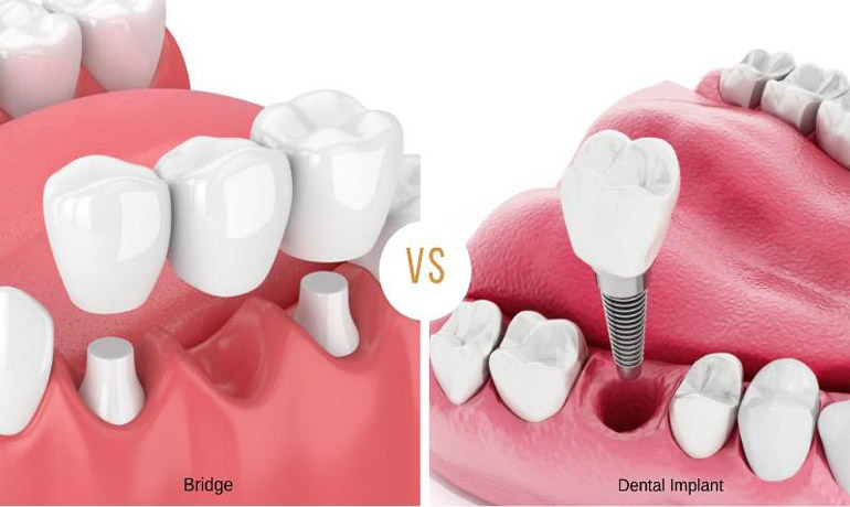 مزیت‌های ایمپلنت دندان نسبت به بریج کدام است؟