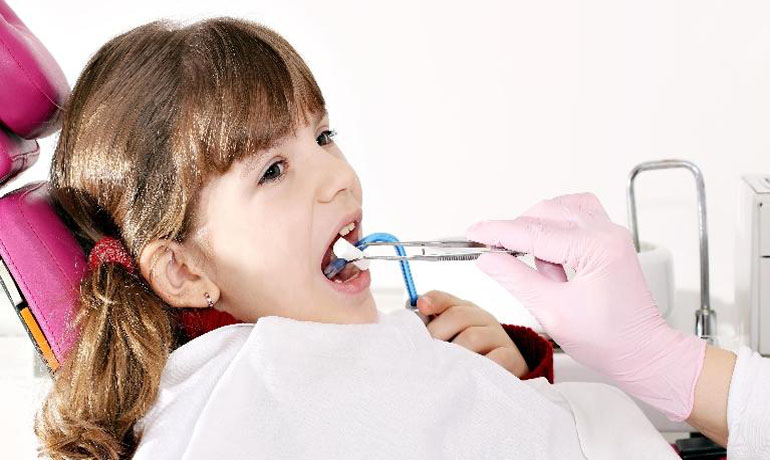 توجه به کشیدن دندان شیری زودتر از موعد