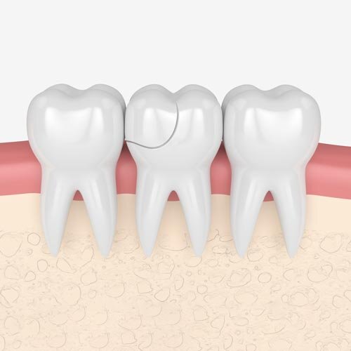 دلایل اصلی ترک خوردن دندان