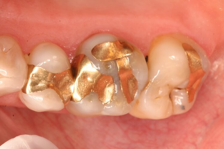 روکش طلا برای دندان