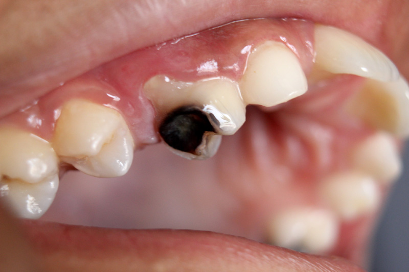 درمان دندان پوسیده شده