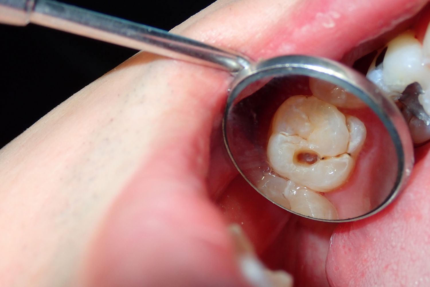 نشانه های پوسیدگی دندان