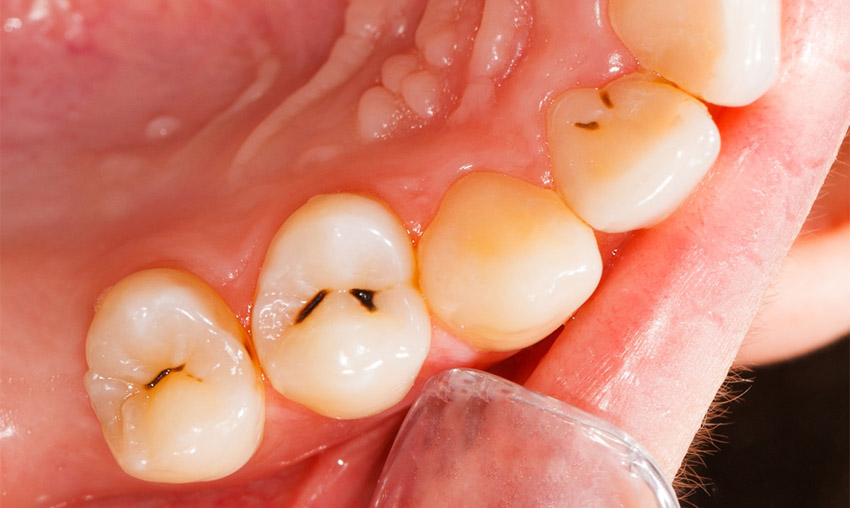 علائم کرم خوردگی دندان چیست و چگونه از آن جلوگیری کنیم؟