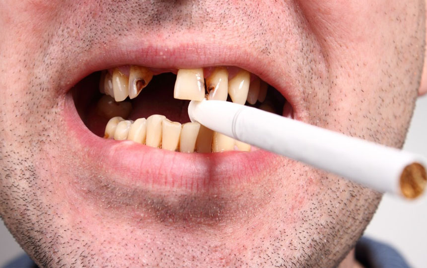 اثرات مخرب سیگار بر دندان‌ها
