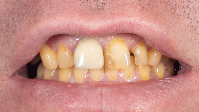زرد شدن دندان