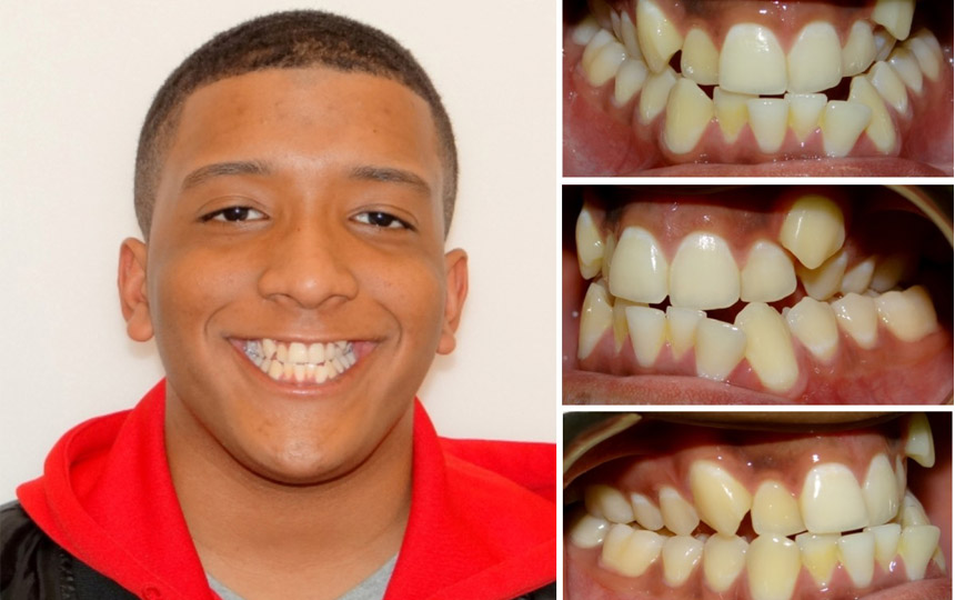 چگونگی درمان کراس بایت دندان