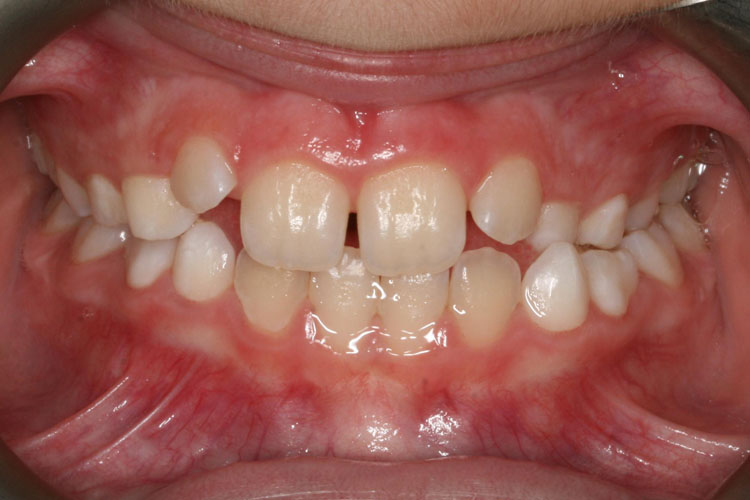 درمان کراس بایت دندان