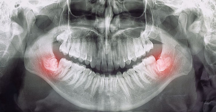 درد دندان عقل