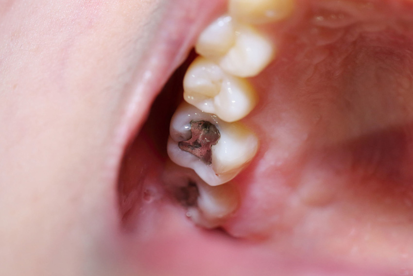 حساسیت به مواد پر کردن دندان