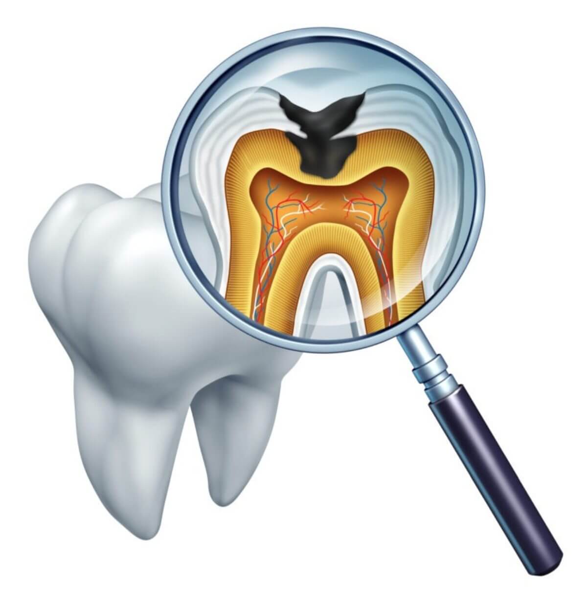 برای جلوگیری از پوسیدگی دندان چه کنیم