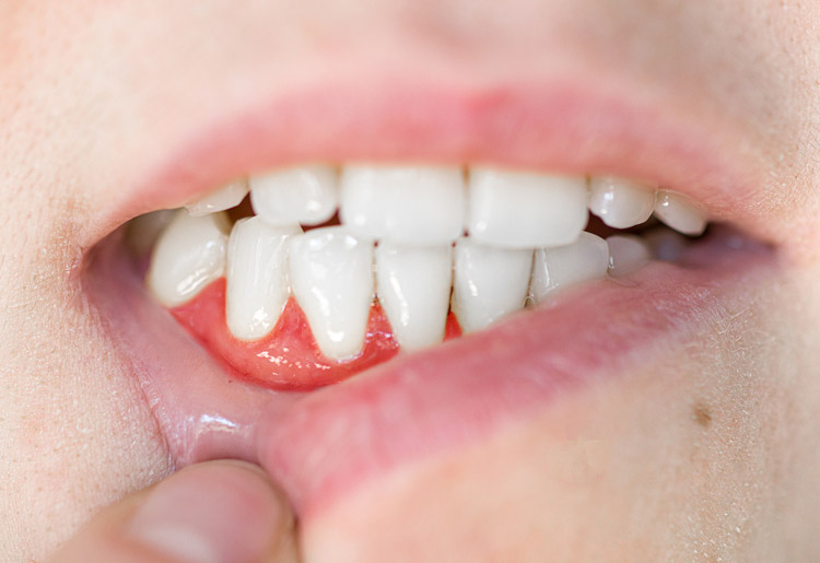 علت آبسه دندان بعد از ایمپلنت