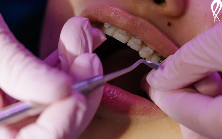 جلوگیری از پوسیدگی دندان در دوران ارتودنسی
