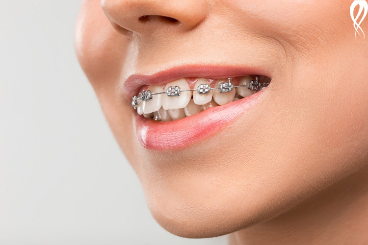 پوسیدگی دندان بعد از ارتودنسی