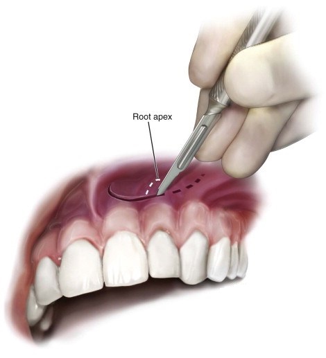 جراحی اپیکواکتومی دندان