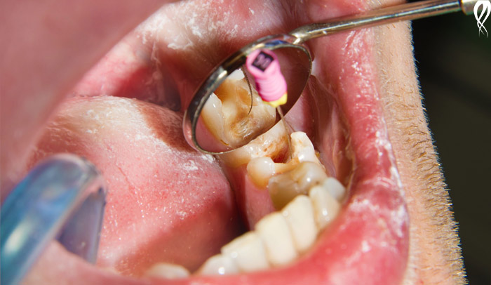 مدت زمان عصب کشی دندان