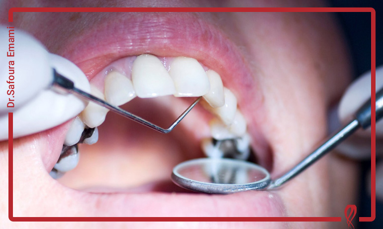 عمر و دوام دندان پر شده چقدر است؟