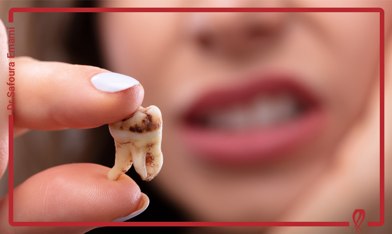 علت نکروز شدن عصب دندان چیست؟