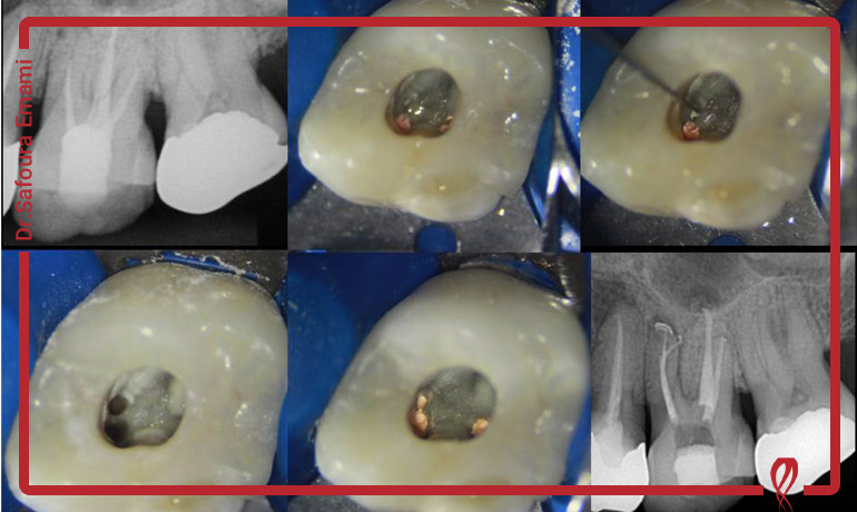 ساده ترین روش پیدا کردن کانال MB2 در دندان های مولر فک بالا