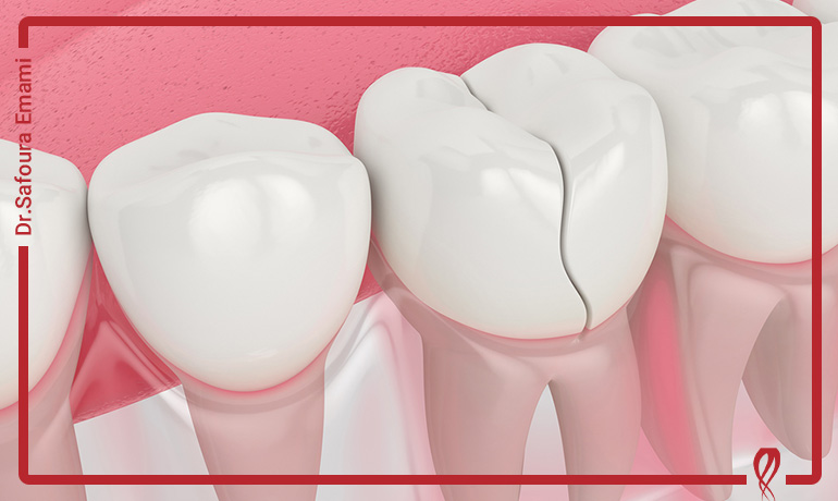 چگونه یک دندان ترک خورده را درمان کنیم؟