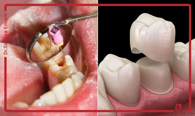 چه نوع ترمیمی برای دندان عصب‌کشی‌شده مناسب‌تر است؟ روکش یا پرکردن؟