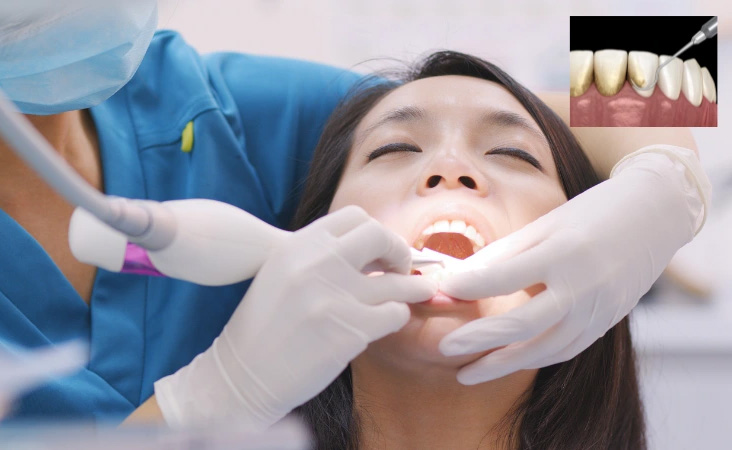 جرم گیری مکرر دندان ها