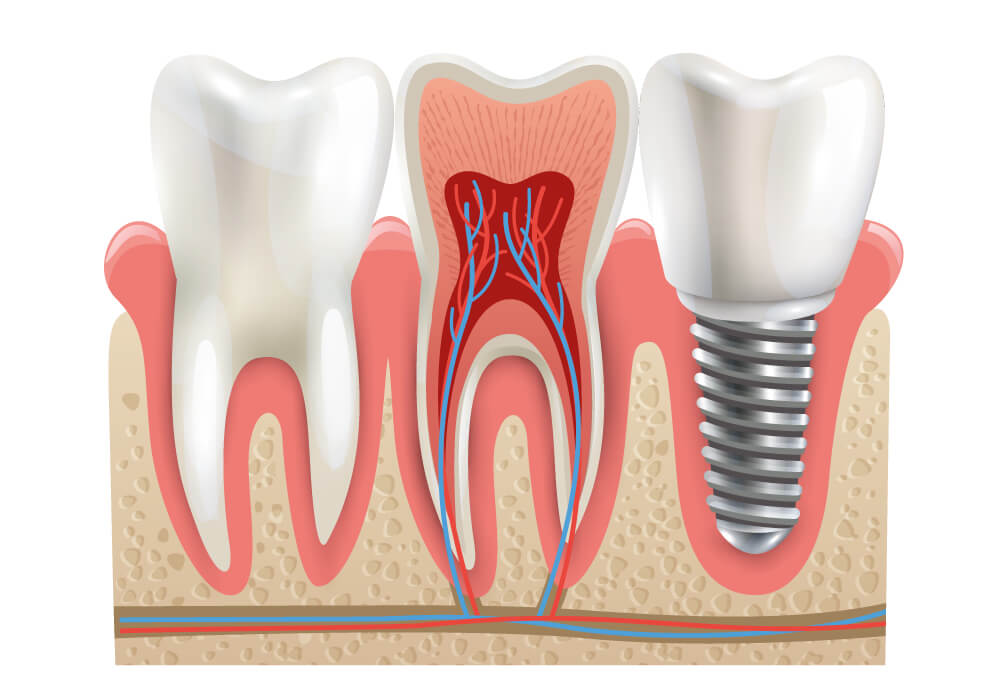 مقایسه تکنیک های کاشت ایمپلنت دندانی