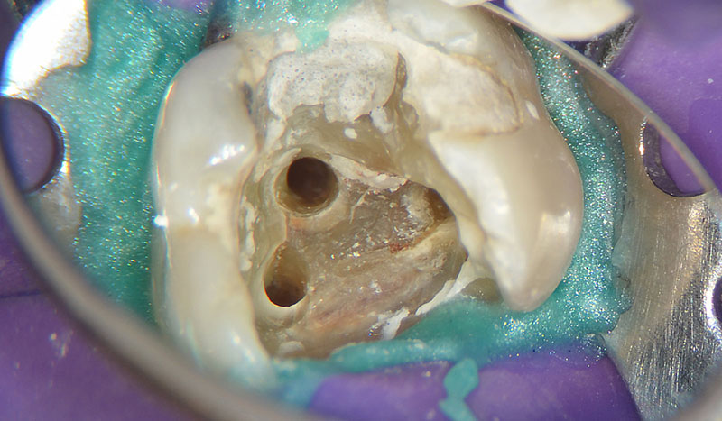 دندان با کانال های کلسیفیه شده