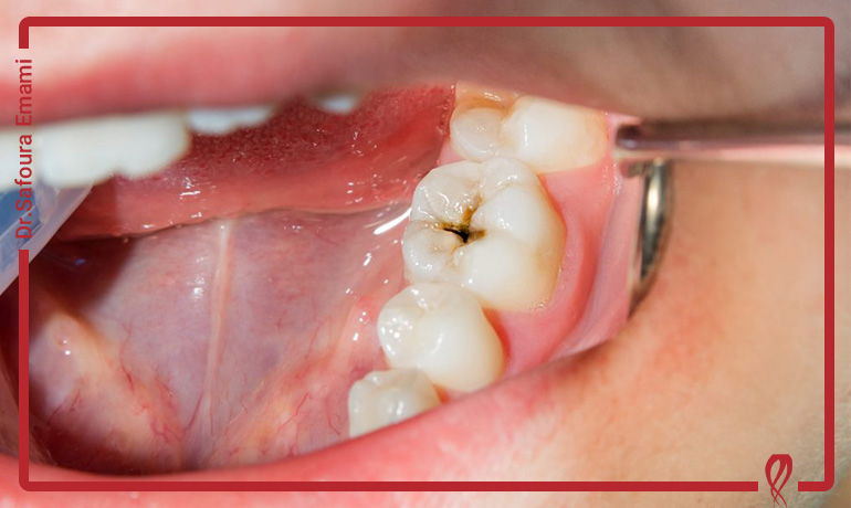 کرم‌خوردگی دندان از کجا شروع می‌شود: راهنمای مرحله به مرحله