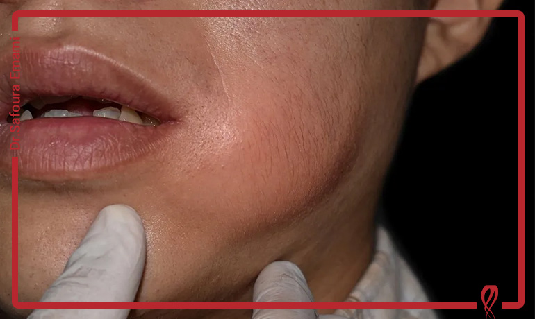 آیا ورم صورت بعد از عصب کشی طبیعی است؟