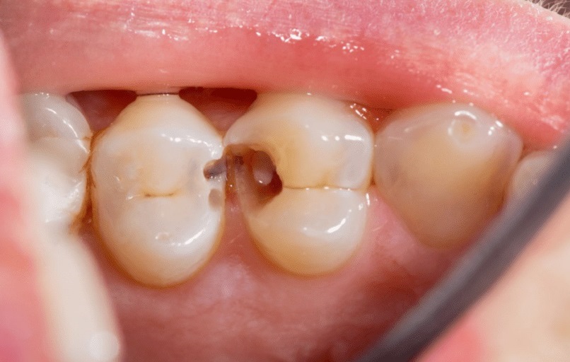 ترمیم دندان پوسیده