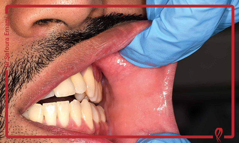 تشخیص زودهنگام شکست درمان ریشه؛ روش‌های کلینیکی و رادیوگرافی