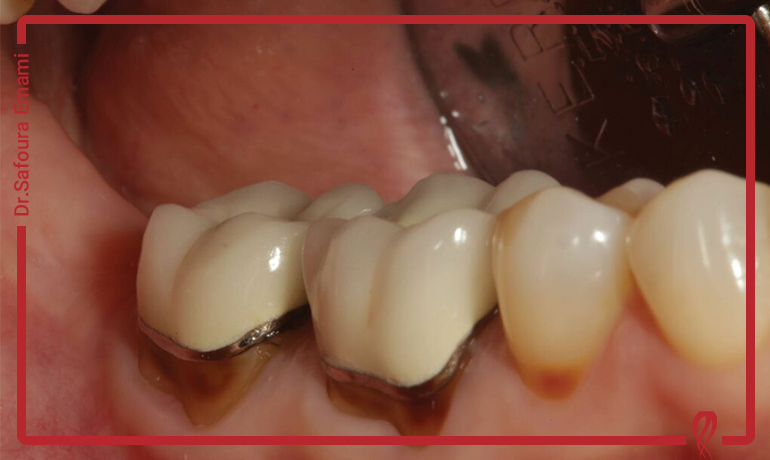 آیا کامپوزیت باعث خرابی و پوسیدگی دندان می شود؟