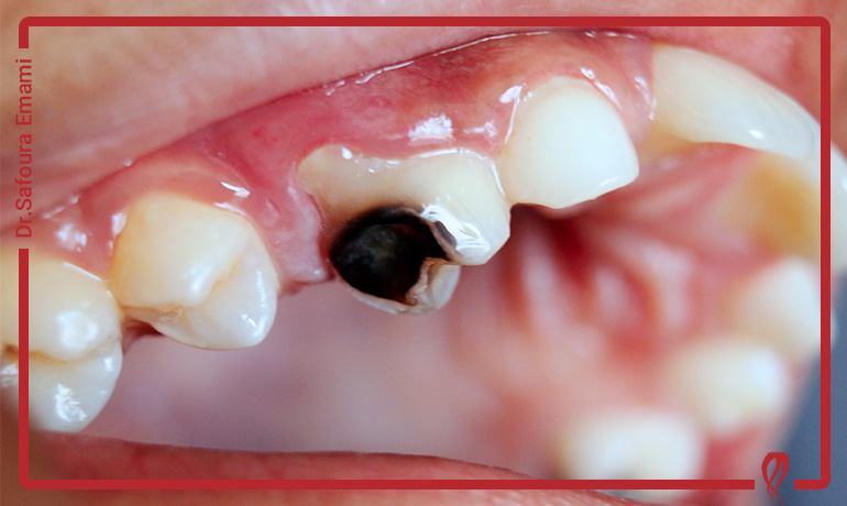 چرا بعضی دندان‌ها سریع‌تر می‌پوسند؟ ۱۰ دلیل پنهان پوسیدگی سریع